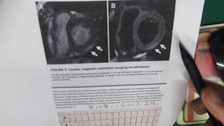 ワクチン後症候群の症例報告論文（JCHO大阪病院）