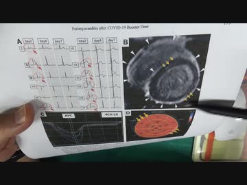 ワクチン後症候群の症例報告論文（自治医科大学）