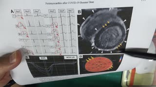 ワクチン後症候群の症例報告論文（自治医科大学）