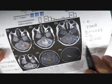 ワクチン後症候群の症例報告論文（石川県立中央病院）