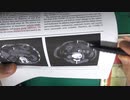ワクチン後症候群の症例報告論文（大分大学）