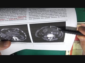 ワクチン後症候群の症例報告論文（大分大学）