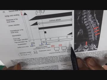 ワクチン後症候群の症例報告論文（石川県立中央病院２）