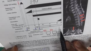 ワクチン後症候群の症例報告論文（石川県立中央病院２）