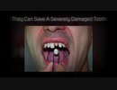 Dental Crowns