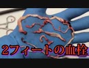 生きている接種者から2フィートの長さの血栓が引き抜かれる。