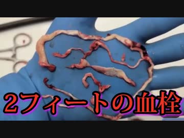 生きている接種者から2フィートの長さの血栓が引き抜かれる。