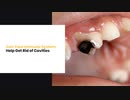 Can Your Immune System Help Get Rid of Cavities