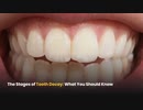The Stages of Tooth Decay What You Should Know