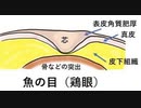 痛い魚の目（杭の形をした角質）の取り方※１回目の５日間スピール膏（角質を溶かすサリチル酸）着けっぱなしだけでは不十分だったので２回目に続きます。@kinoshitayakuhi