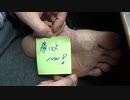 左足たこ、自分で治療【74日目】help me Japan　Please subscribe to our channel.
