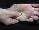 左足たこ、自分で治療：help me Japan