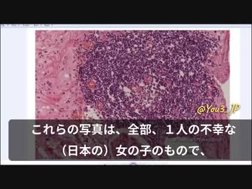 接種後突然死した日本の14才の痛ましい少女のことが世界中で話題