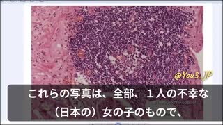 接種後突然死した日本の14才の痛ましい少女のことが世界中で話題