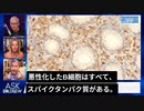 ライアン・コール博士が「ワクチンと癌の関係」について。スパイクタンパクがすべての悪化したB細胞にある！