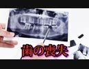 ワクチン接種後に歯を失う人が続出