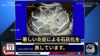 ナオミ博士：ワクチン接種後、妊婦胎盤の怖い超音波画像。著しい炎症による石灰化。胎児の羊水の量を減少させ、著しい成長遅延に。