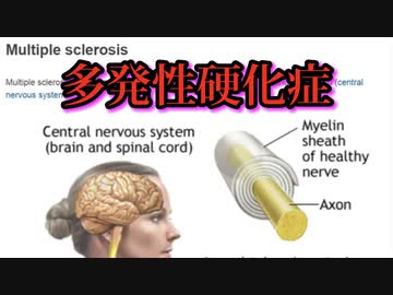 COVID-19 mRNAワクチン、多発性硬化症を引き起こす