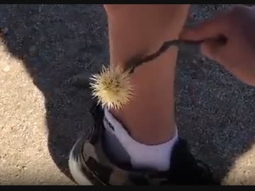 ホモと見る足に刺さったイガ栗の除去