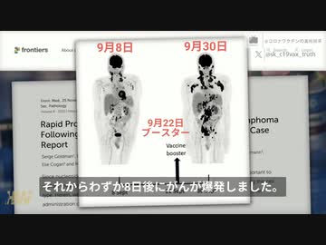 腫瘍内科専門家マキス医師：最初のターボがんの画像症例報告、ブースター接種して、８日でがんが全身に蔓延。