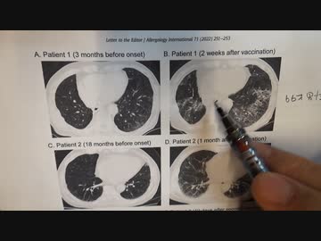間質性肺炎（自己免疫疾患）増加を隠す目的