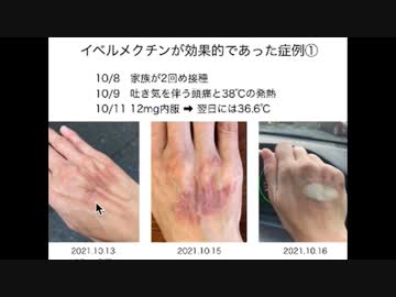 イベルメクチンのシェディングに対する効果を紹介