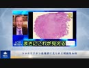 コロナワクチン接種者に見られる繊維性血栓