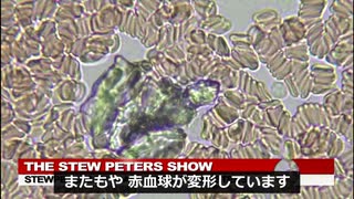 567枠沈後遺症は赤血球凝集による酸素不足が主な原因⇔酸化グラフェンが主原因