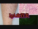 IgA血管炎、COVIDワクチンにより誘発
