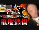 【2016年】シラミ駆除剤で火だるまになった少女 12歳で体の55%に重度熱傷を負い変わり果てた姿になり、100回以上の手術…【ゆっくり解説】