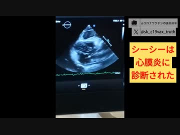 ワクチン血は致命的かも。接種者の血を輸血受けた後心膜炎。（事実要確認）