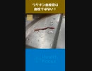 ワクチン血栓症は血栓ではない！