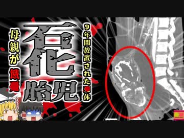 【2023年】『リソペディオン』　｜女性「お腹から変な音がする…」→腹部に石灰化した胎児が埋まっていた女性 ｜医者への不信から10年病院にかからず栄養失調で〇亡【ゆっくり解説】