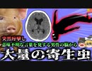 【2021年】意味不明な言葉を発し痙攣した男性 脳を調べるとそこには大量の白い影…『マサチューセッツ 有鈎の嚢虫感染症』【ゆっくり解説】