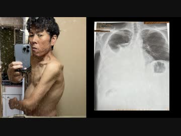 ホモと見るついに胸水で肺が埋まってしまった例の配信者