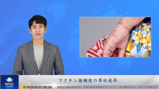 ワクチン接種後の帯状疱疹