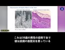 ドイツの病理学者、アルネ・ブルクハルト（Arne Burkhardt ）博士：   新型コロナワクチン接種を受けた人は、急に老けて見えるという非常に説得力のある報告があります