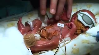 生きるということ　（妊娠24週の早産）