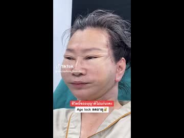 ホモと見る顔のしわを伸ばす手術