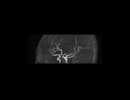 脳血管MRI（MRA）