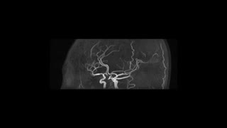 脳血管MRI（MRA）