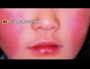 妊婦が感染すると流産や死産のおそれも・・・「リンゴ病」警報レベルに　前の週の2.22倍　福岡