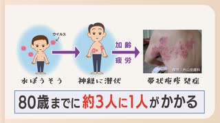 「帯状疱疹」に注意　4月から65歳以上にワクチン定期摂取スタート　50代から急増　女性の割合が高いというデータも
