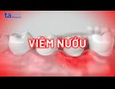 Viêm nướu: Nguyên nhân, triệu chứng và cách điều trị an toàn