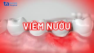 Viêm nướu: Nguyên nhân, triệu chứng và cách điều trị an toàn