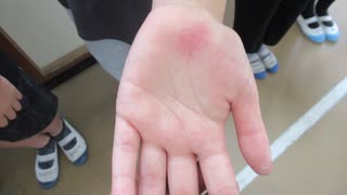 プール授業で児童25人が”手に湿疹としびれ”　原因はプールサイドに手をついたことによる圧迫痕の可能性　北九州市教委が会見