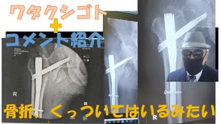 日本に核を持たせたい人達、おそろしい！トラ氏がDS排除の為にデフォルトさせるかどうか？無理ではないか！←コメ【アラ還・読書中毒】私事：骨折した右足付け根が前より痛くなってレントゲン取ってもらいました