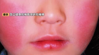 頬が赤くなる「リンゴ病」佐賀県で初の警報　福岡県も警報レベル続く　定点あたりは過去2番目の多さ