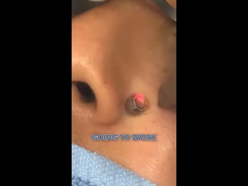 ホモと学ぶレーザーほくろ除去