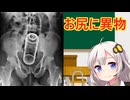 おしりに入った異物　解説